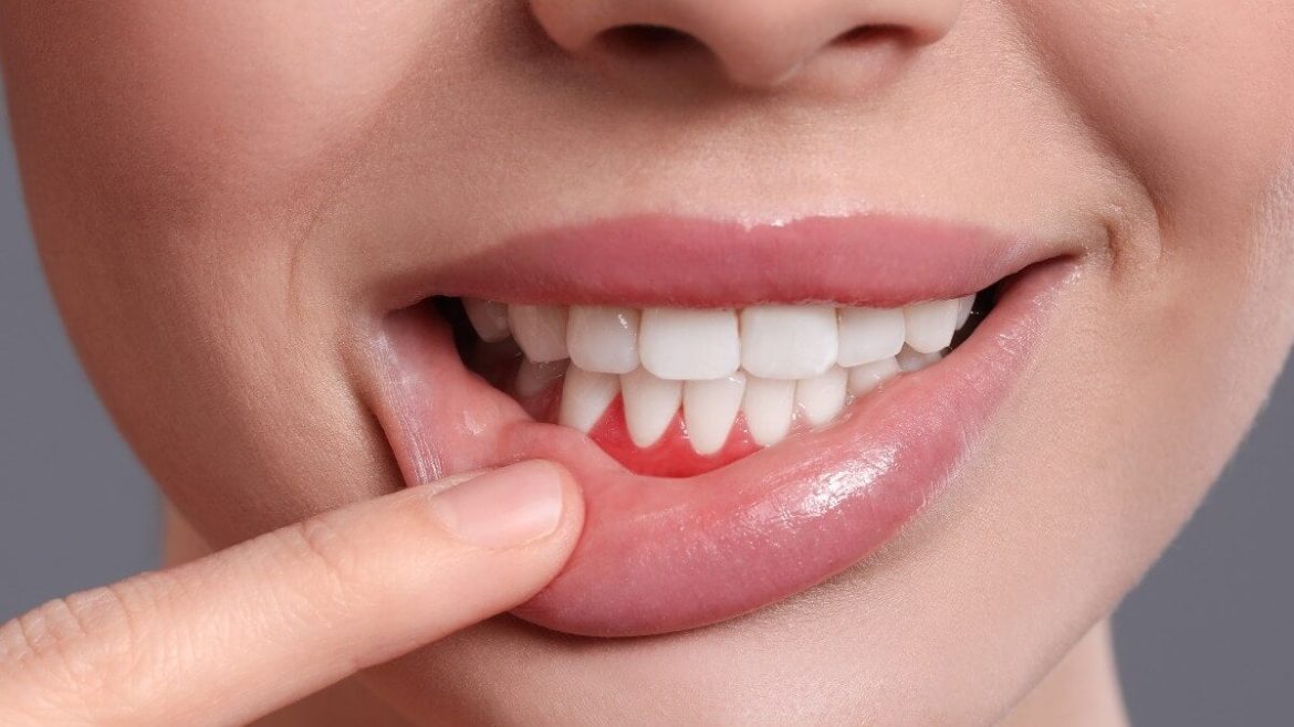 ¿Cuál es la diferencia entre gingivitis y periodontitis?