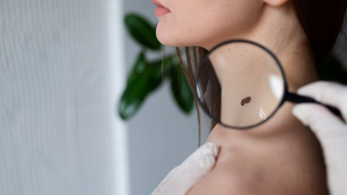 ¿Por qué aparecen las verrugas en el cuello y cómo eliminarlas?