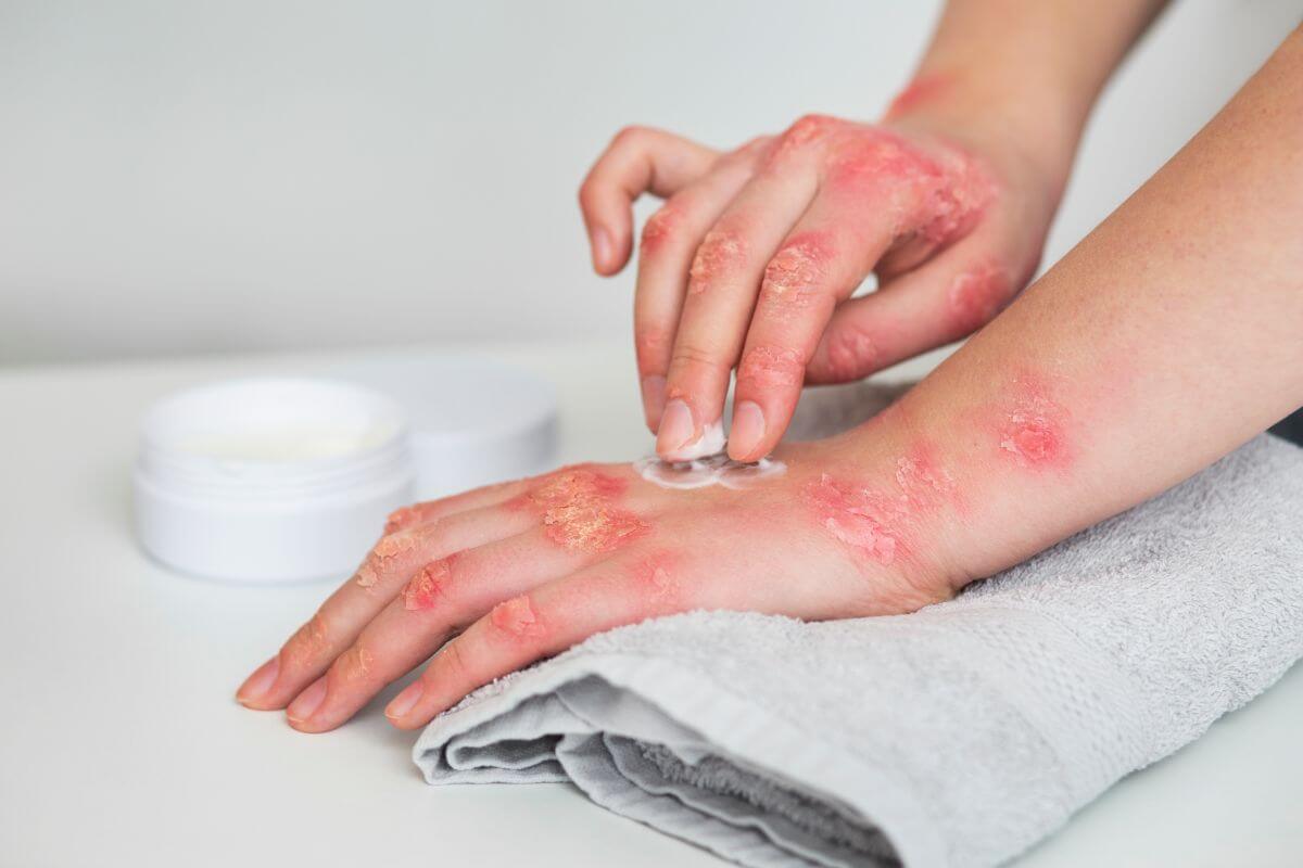 Qué es la psoriasis nerviosa y cómo identificarla