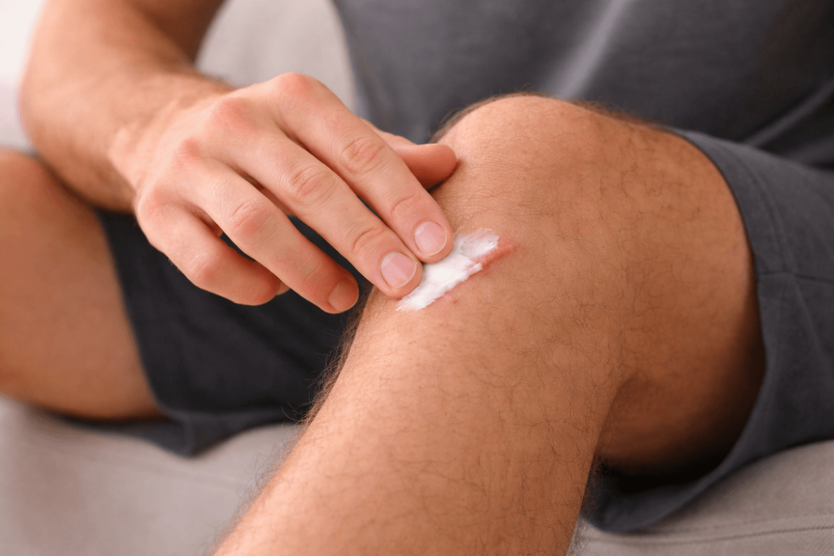 Cómo mejorar el aspecto de una cicatriz: 6 opciones naturales y cómo usarlas