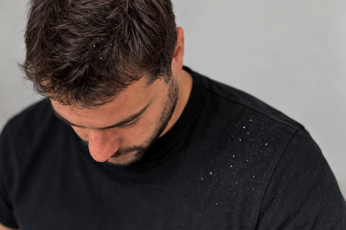 ¿Caspa hasta en los hombros? 5 formas realistas de controlarla mejor